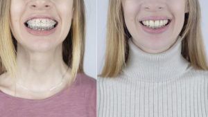 Read more about the article Braces Before and After