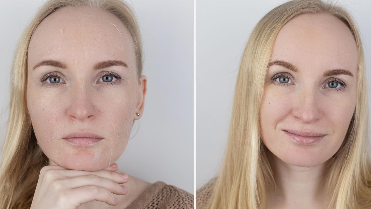 Read more about the article Chemical Peel Before and After