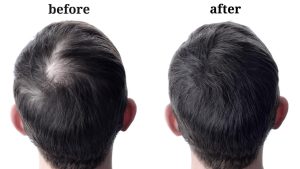 Read more about the article Hair Transplant Before and After