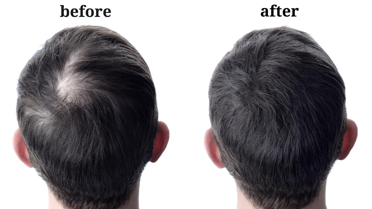 You are currently viewing Hair Transplant Before and After