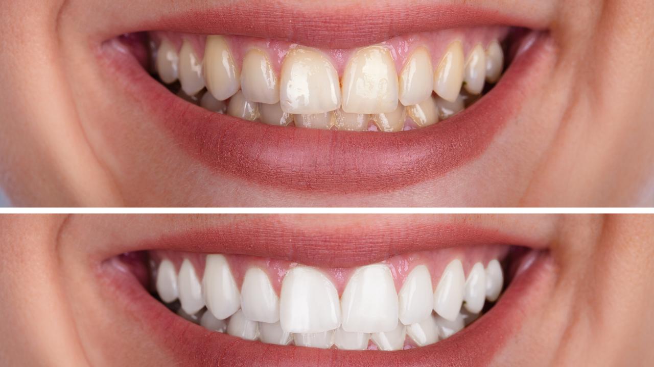 Read more about the article Invisalign Before and After