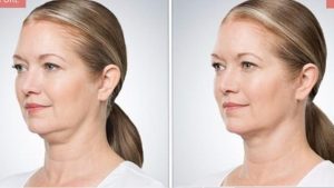 Read more about the article Kybella Before and After