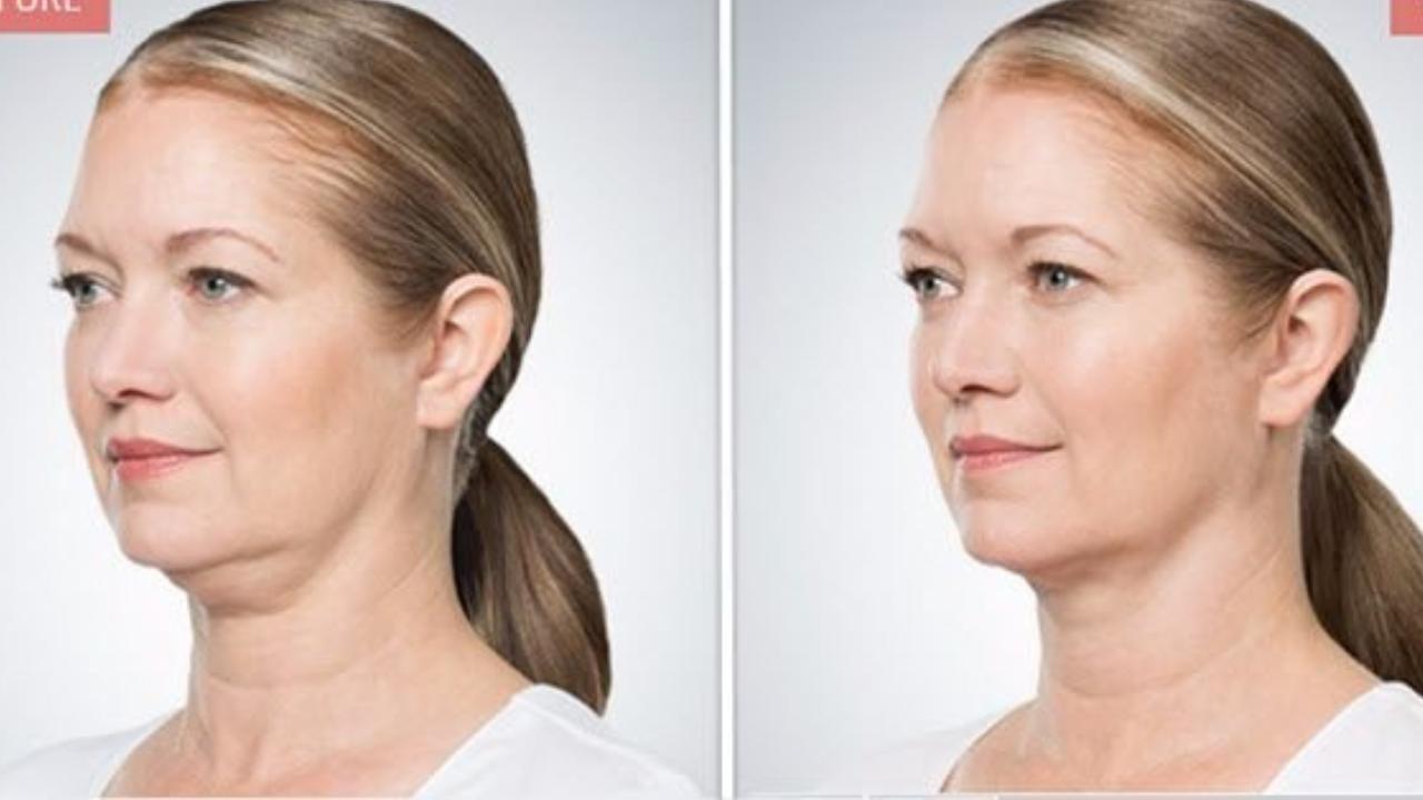 You are currently viewing Kybella Before and After