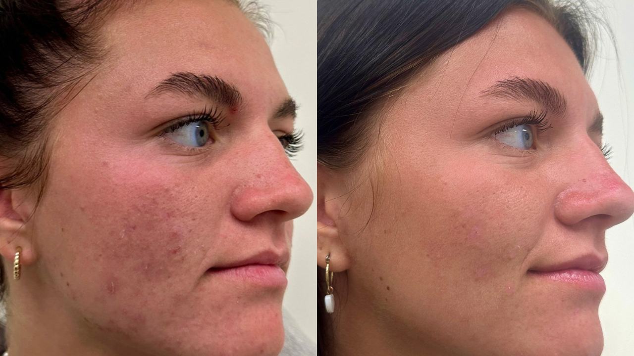 Read more about the article Microneedling Before and After Treatment