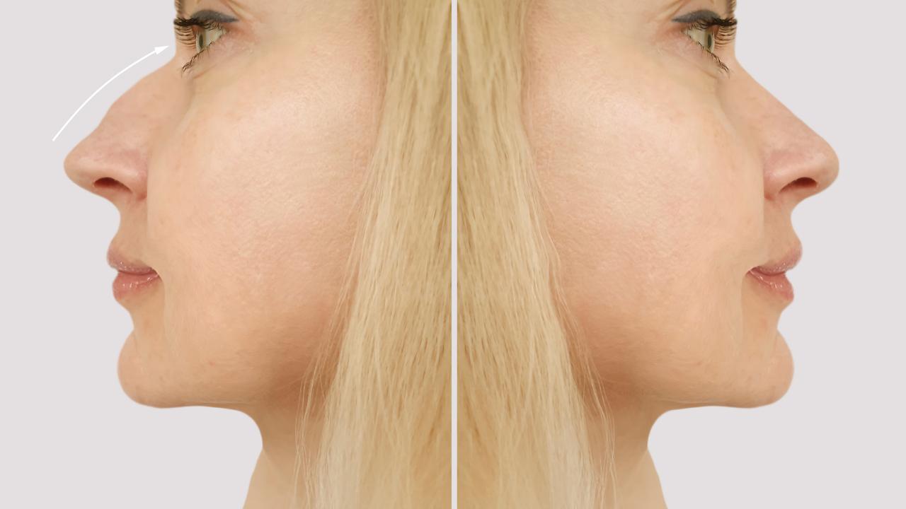 Read more about the article Nose Job Before and After