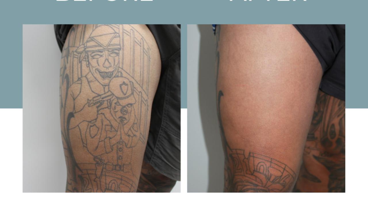 You are currently viewing Tattoo Removal Before and After