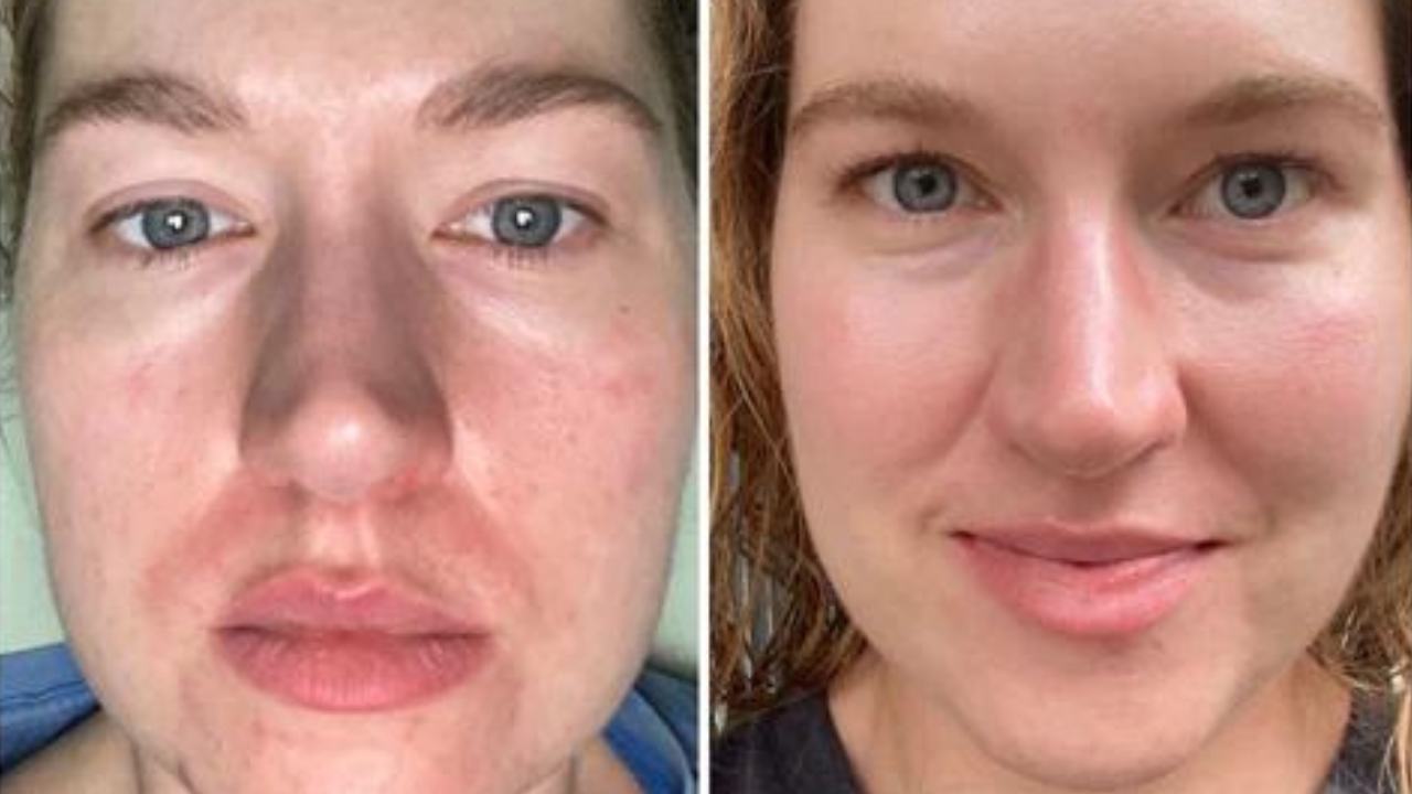 Read more about the article Tretinoin Before and After